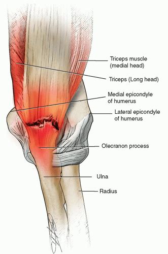 Torn Triceps Tendon – A Rare But Serious Injury | SportsMD