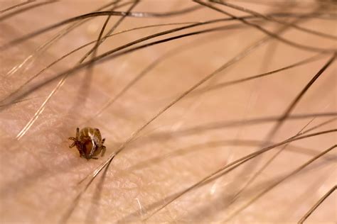 What To Do About Chiggers and Chigger Bites In Mississippi - Synergy²