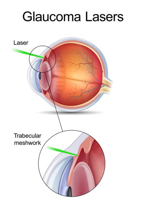 Glaucoma-Lasers - Papale Eye Center