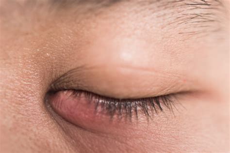 Blocked Tear Duct – Symptoms, Causes, and Treatment | Diamond Vision