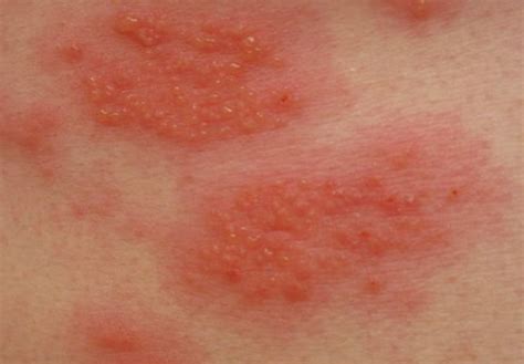 Contact Dermatitis - Pictures, Symptoms, Causes, Treatment | HubPages
