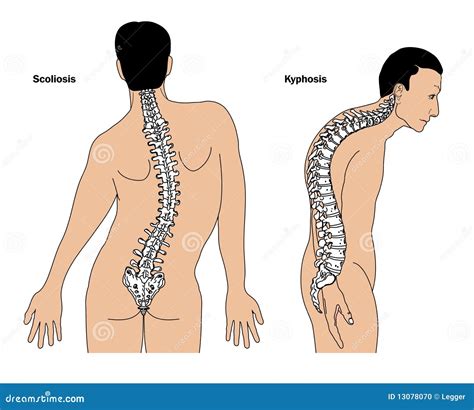 Spinal deformities stock vector. Illustration of science - 13078070