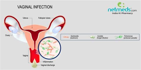 Vaginitis: Causes, Symptoms And Treatment