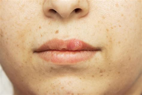 Hiv Symptoms On Lips