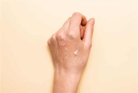 Peeling Skin: Causes, Symptoms, & Medical Treatment