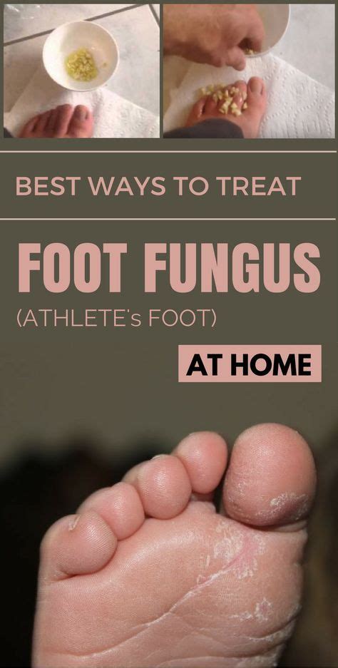 How To Keep From Spreading Athlete's Foot