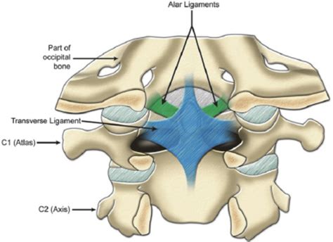 Comorbidity Burden Associated With Poor Outcomes in Atlantoaxial Fusion | OrthoSpineNews