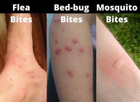 Bed Bug Bites Pictures, Symptoms: What Do Bed Bug Bites Look Like? | lupon.gov.ph