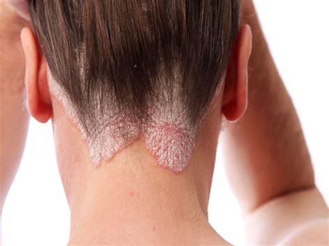 Causes And Treatment Of Seborrheic Dermatitis Hair Loss!, 56% OFF