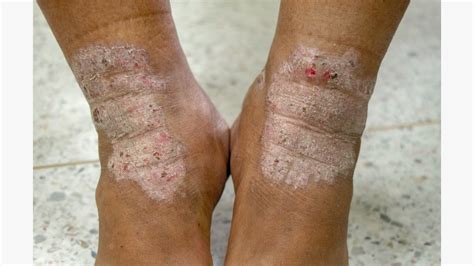 Dyshidrotic Eczema Feet