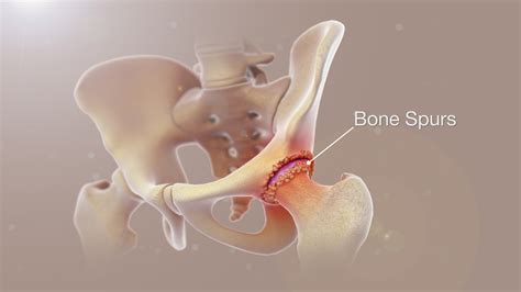 Bone Spurs Shown and Explained Using Medical Animation Still Shot