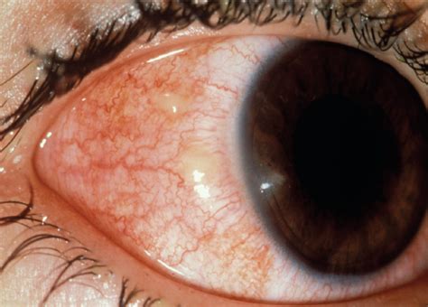 Corneal Manifestations of Systemic Diseases | Consultant360