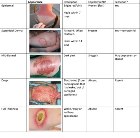 Pondering Paeds: Burn, Baby, Burn (Part 1) - Ponder Med