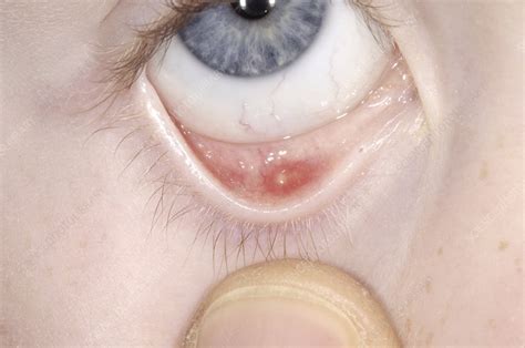 Cyst (chalazion) on eyelid - Stock Image - M155/0595 - Science Photo ...