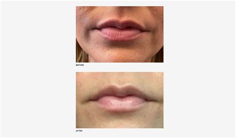 Botox Lip Flip vs. Lip Filler: Pain Level & Results | RealSelf News