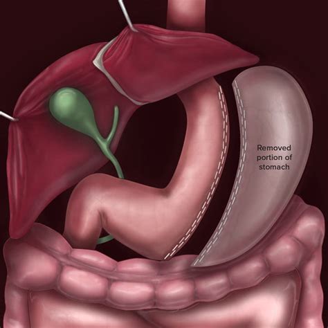 Sleeve Gastrectomy | Ohio State Bariatric Surgery