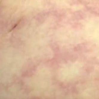 Mottled Skin - Pictures, Meaning, Causes, Symptoms, Treatment