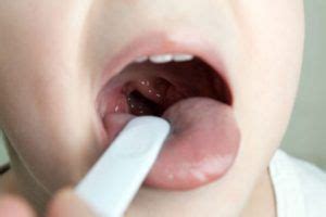 14 Natural Remedies For Uvulitis – Get Faster Relief