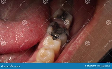 Decayed Tooth Root Canal Treatment. Tooth or Teeth Decay of Lower Molar ...