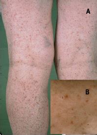 A/B Multiple erythematous macules and papules on the lower extremities... | Download Scientific ...