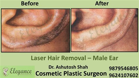 Ear Hair Removal with Laser in Surat, Gujarat