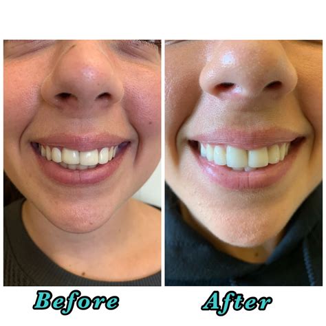 Porcelain Veneers Gone Wrong, what to do? - Sola Dental Spa