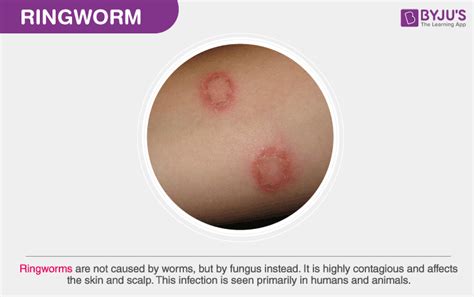 What Is a Ringworm? - Causes, Types, Symptoms, Treatment