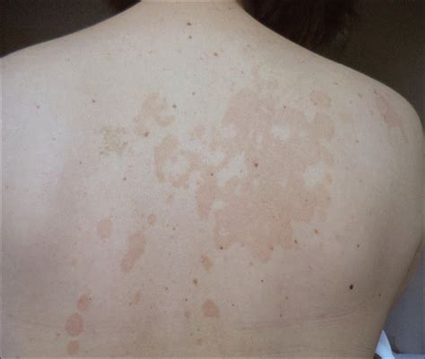 Tinea Versicolor Best Treatment at Kendra Hernandez blog