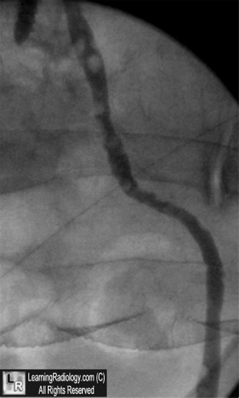 LearningRadiology - Ureteritis, Cystica, ureter, ureteral, irregular, defects, radiology