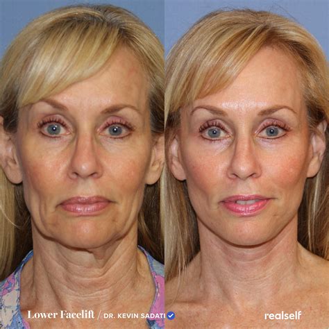 Lower Facelift vs. Neck Lift: What’s the Difference? | Neck lift, Face lift surgery, Instant ...