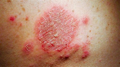 Common Skin Rashes | Everyday Health - BOB电竞手机APP