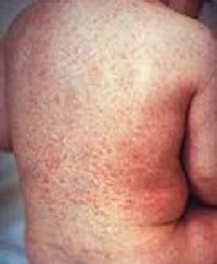 Rubella Virus: Structure and Function | Study.com