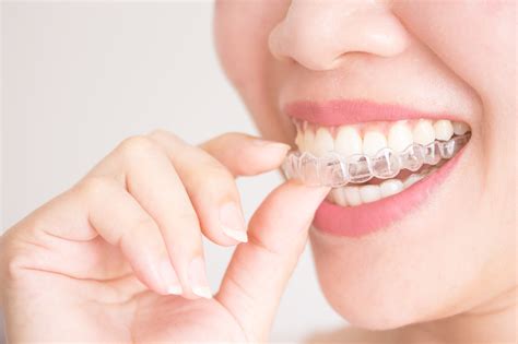 Clear Teeth Aligners: 3 Tips for Success - HealthyMenStore