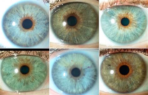 NewEyes Laser: the true & safe eye color change - Clínica Eyecos - Cambio color de ojos