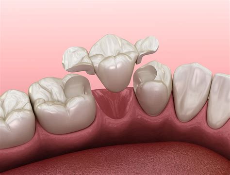 The different types of Crowns and Bridges - London Specialist Dentists