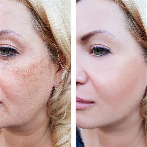 Cheeks Broken Capillaries Laser Treatment – Modern Beauty Bar