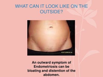 Lets talk about Endometriosis and Bloating - Couch bound reality