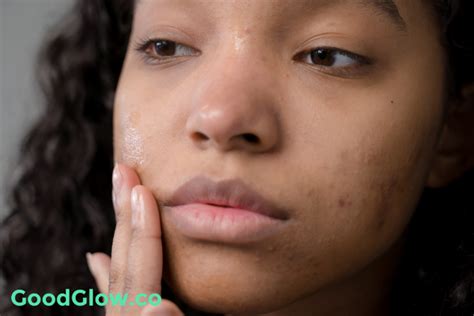 8 Best Moisturizers For Hormonal Acne Breakouts - GoodGlow