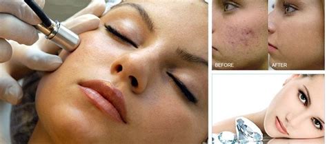 What Is Diamond Dermabrasion And Is It Better Than Microdermabrasion For Acne?