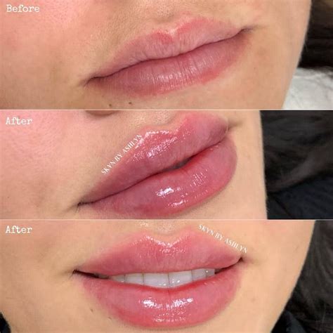 Best of Cosmetic Dermatology on Instagram: “Before/after lip filler 😍 ...