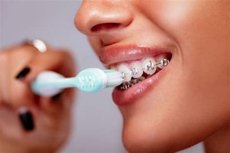 Whitening Your Teeth With Braces: What are Your Options?