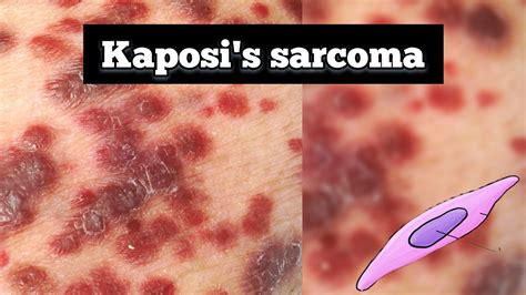 Kaposi's Sarcoma-associated Herpesvirus Wikipedia, 43% OFF