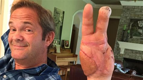 GRAPHIC PHOTOS: Fireworks Injury Victim Shares Photos | WBFF