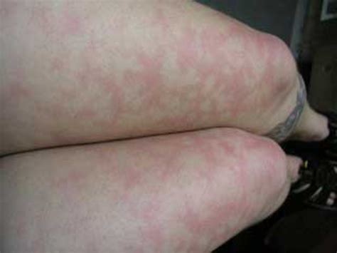 What Causes Blotchy Skin on Legs? - YouMeMindBody