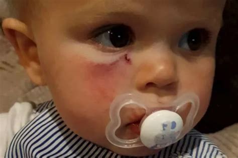 Toddler traumatised after dog bites face - just missing her eye - Nottinghamshire Live