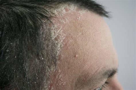 Mild Scalp Psoriasis Symptoms