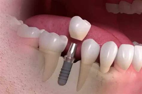 Single tooth dental implant in Brazil - ImplArt Implantes