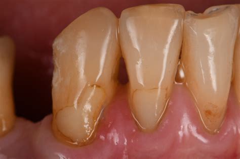 Extreme Class V cervical abrasion lesions