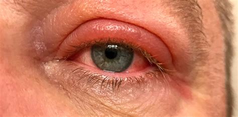 Ophthalmology Diagnosis Blepharitis Snellen Eye Chart - vrogue.co