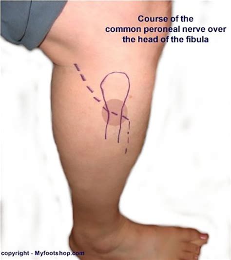 Common Peroneal Neuropathy